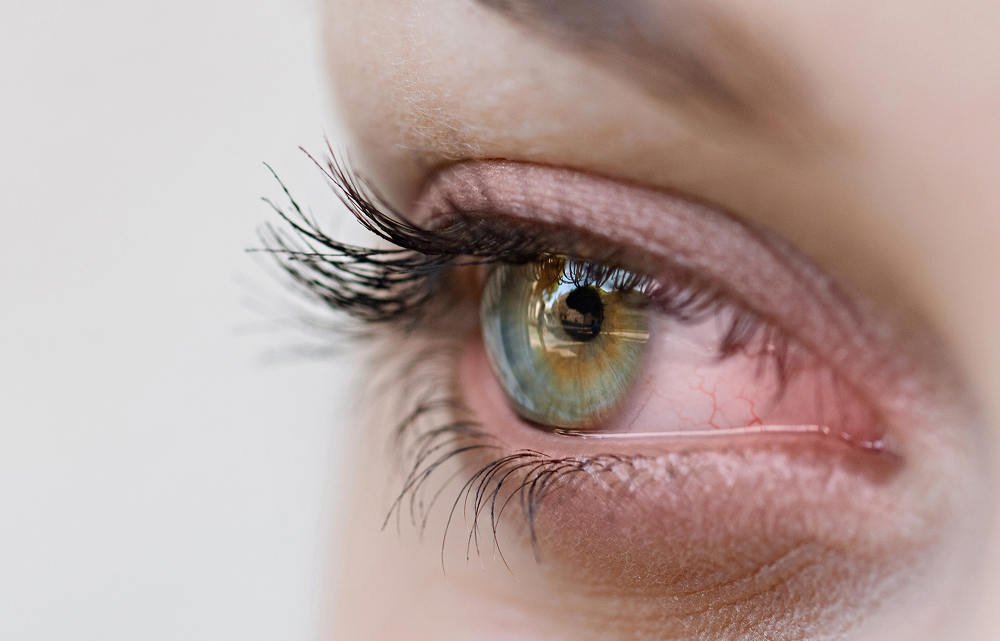 Что делать, если линза потерялась, застряла в глазу?